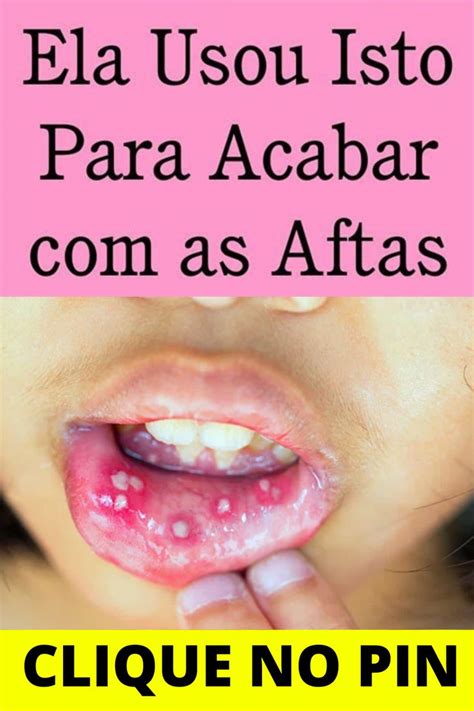 Como Curar As Aftas - 4 receitas caseiras para acabar com as aftas | Aftas na boca, Como ...