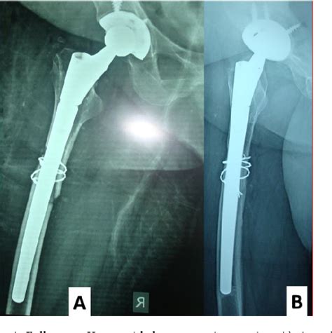 Figure 2 From Cementless Long Stem Total Hip Replacement For Revision