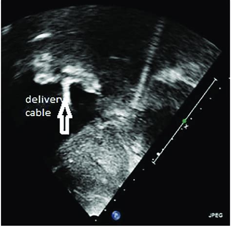 Using Transthoracic Echo During The Procedure Subcostal View Showing