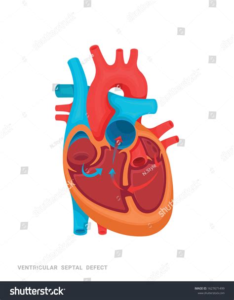 Heart Defect Ventricular Septal Defect Royalty Free Stock Vector