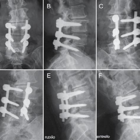 Case 1 A And B Ap And Lateral Radiographs At 1 Year Postoperatively