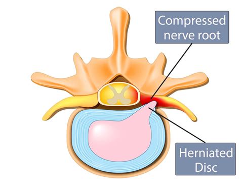 Herniated Disc Diagram