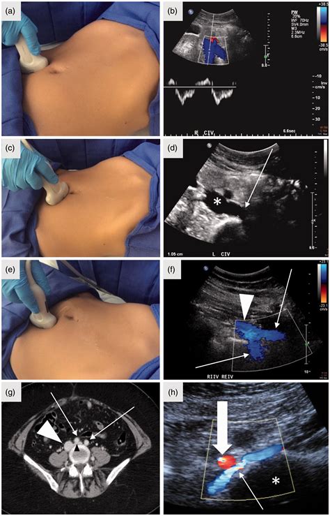 A Standardized Ultrasound Approach To Pelvic Congestion Syndrome