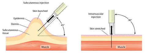 Intramuscular Injection Sites Testosterone