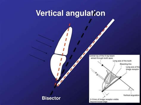 Bisecting angle technique