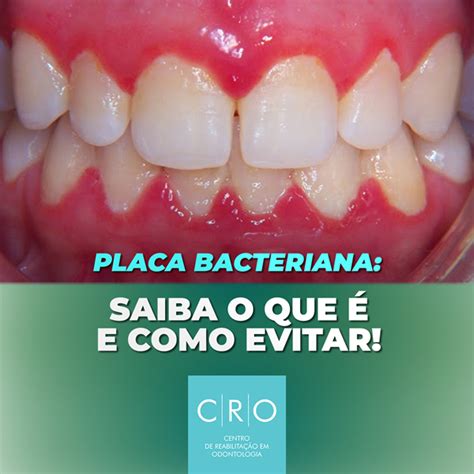 Placa Bacteriana CRO Odontologia