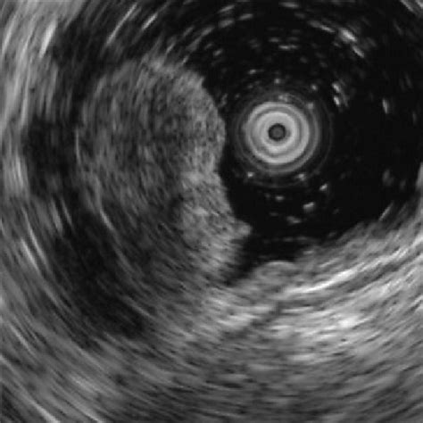 Endoscopic Ultrasonography Revealed A Homogeneous Hypoechoic Lesion Of Download Scientific