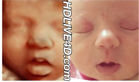 Before After Photo Gallery D Hdlive D D Hd Ultrasound Virginia