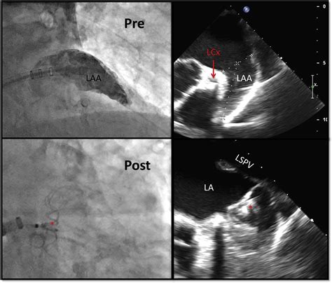 Left Atrial Appendage Exclusion For Atrial Fibrillation Cardiology