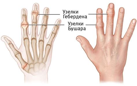 Остеоартроз: Причины, Симптомы, Лечение - Блог Врача о Здоровье