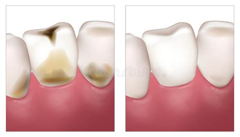 Dental Cavities Dental Caries Cavities Caries Tooth Decay And