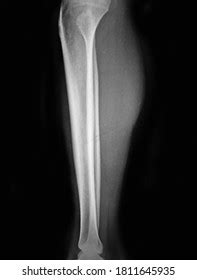 Xray Normal Human Tibia Lateral View Stock Photo 1811645935 Shutterstock