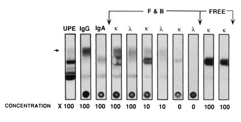 Figure 4 From Urine Protein Electrophoresis And Immunofixation