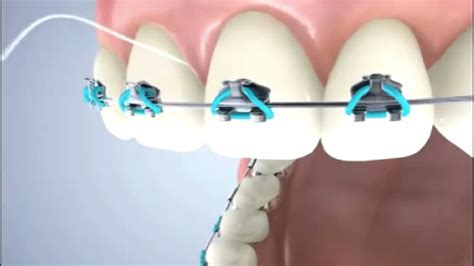 C Mo Usar Hilo Dental Con Brackets Youtube