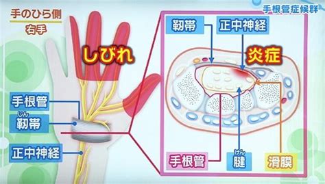 【健康】手のしびれの原因について 28の未来へ