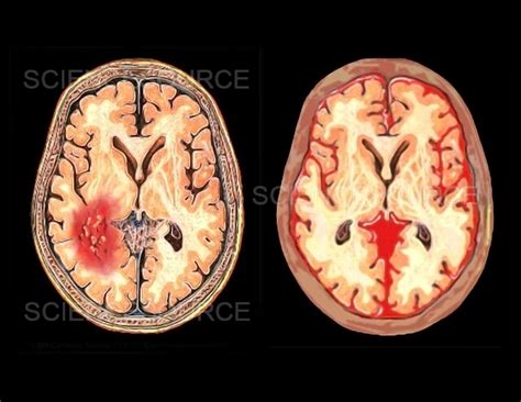 Subdural Hematoma Vs Subarachnoid Hemorrhage