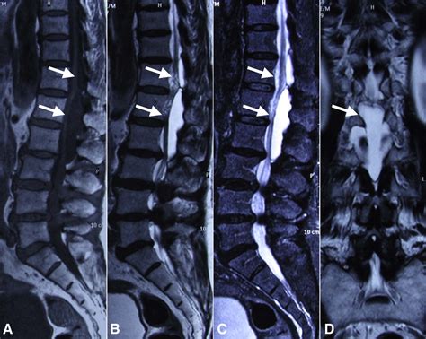 Spinal Extradural Arachnoid Cyst In Aging Spine The Spine Journal