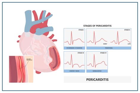 Pericarditis Symptoms Causes Diagnosis Prevention