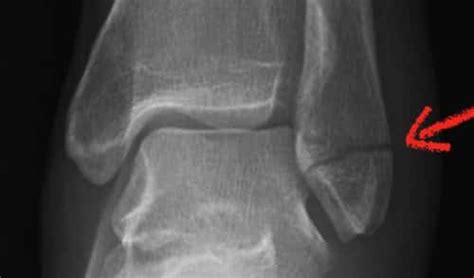 Lateral Malleolus Fractures: Symptoms, Treatment, Recovery Time