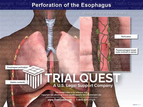 Tearing Perforation Of The Esophagus As Related To Achalasia Pictures