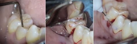 Restoring The Unrestorable Surgical Extrusion Style Italiano Endodontics