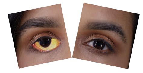 Scleral icterus - rewaclubs