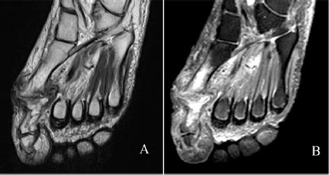 Figure 5 From The Evaluation Of Mri In Diagnosis Of Osteomyelitis In Diabetic Foot Semantic