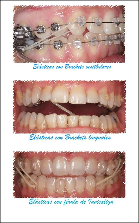 Erlendis Keppni Hringur Para Que Sirven Las Gomas Elasticas En