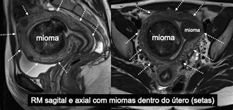 Emboliza O Uterina No Tratamento De Miomas Dr Tiago Bilhim