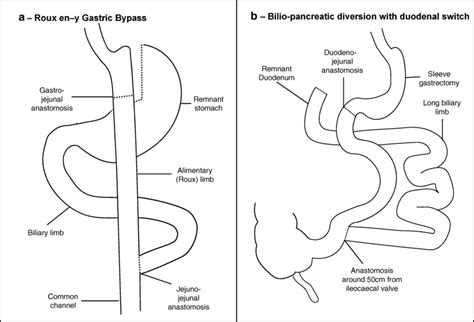 Diagrammatic Representation Of Roux En Y Gastric Bypass A And