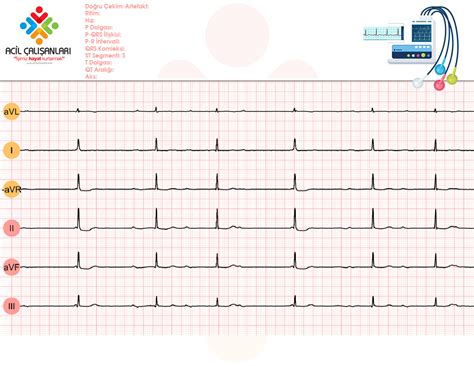 Derece Atriyoventrik Ler Av Blok Tam Kalp Blo U Acil Al Anlar