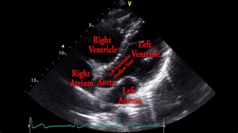 Echocardiogram Apical Five Chamber View Loop Youtube