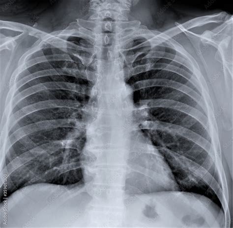 chest x-ray of an adult .diagnosis of pneumonia Stock Photo | Adobe Stock