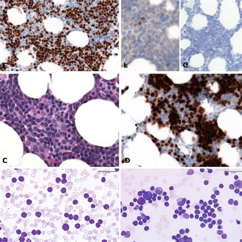 Mantle Cell Lymphoma Mcl With Blastoid Morphology Low Sox11