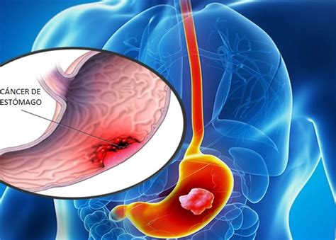 Cáncer De Estómago Causas Síntomas Tratamientos Y Más