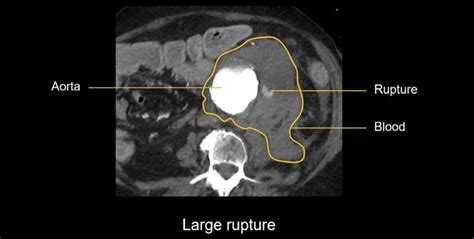 Abdominal CT: aortic aneurysm • LITFL • Radiology Library