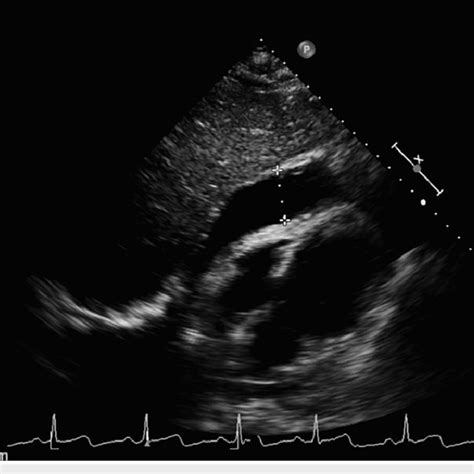 Transthoracic Echocardiogram In Subcostal Four Chamber View