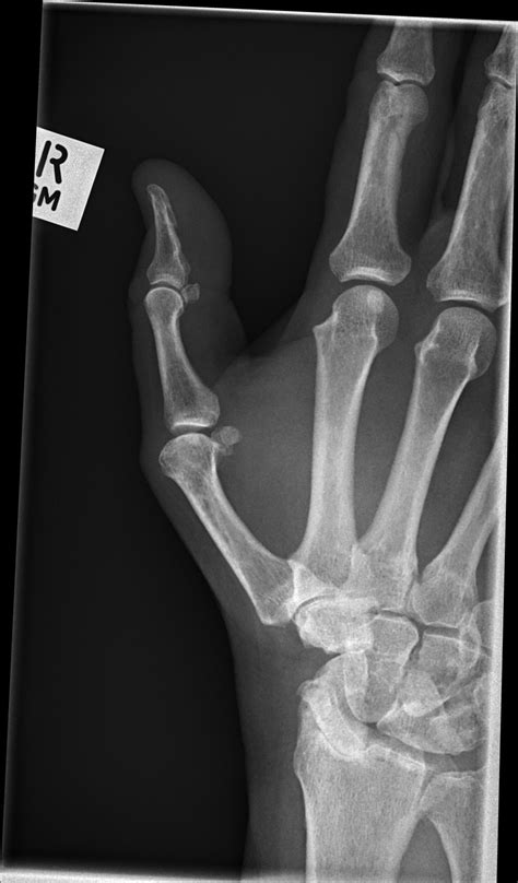 Scapholunate Advanced Collapse Thumb X Ray Image Radiopaedia Org