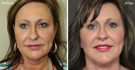 How Can A Facelift Change Your Appearance The Lett Center