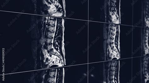 MRI Scan, Magnetic Resonance Images, of the spine Stock Photo | Adobe Stock