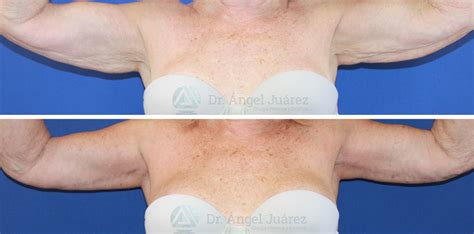 Lifting De Brazos O Braquioplastia Doctor Ngel Ju Rez Cirujano Pl Stico