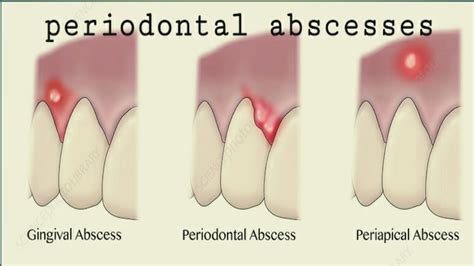 Periodontal Abcsess 2 Peridontic Abscess Gingiva Youtube