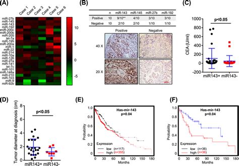 Mir P Is Correlated With The Bm And Progression Of Lung Cancer A