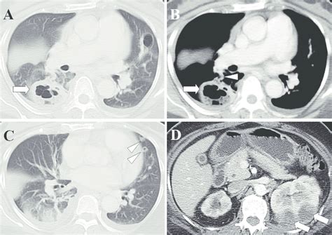 Renal Abscesses With Septic Pulmonary Emboli A A Lung Window Of A Download Scientific