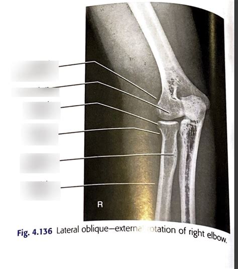 Lateral Oblique External Rotation Elbow Diagram Quizlet