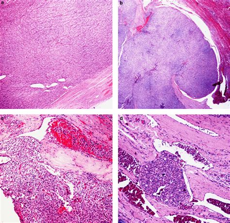 Follicular Thyroid Carcinoma Modern Pathology