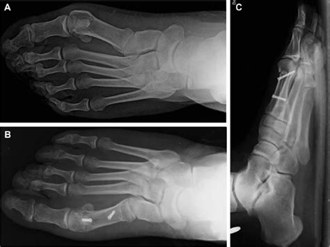 Preoperative Antero Posterior A Postoperative Anteroposterior B Download Scientific