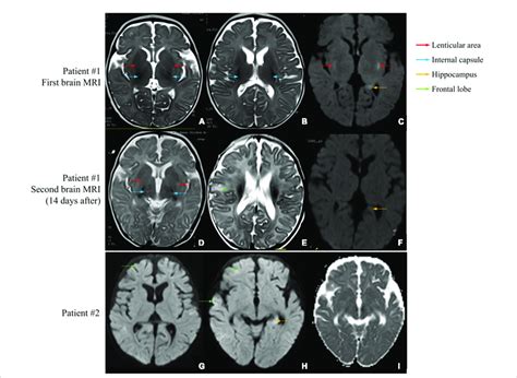 Brain MRI scans of patients #1 and #2. (A-C) First brain MRI ...