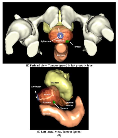 Geometric Anatomy Basis For Safe And Effective Focal Ablation Of