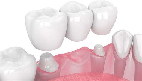 Porcelain Crowns And Bridges Crowsnest Dental